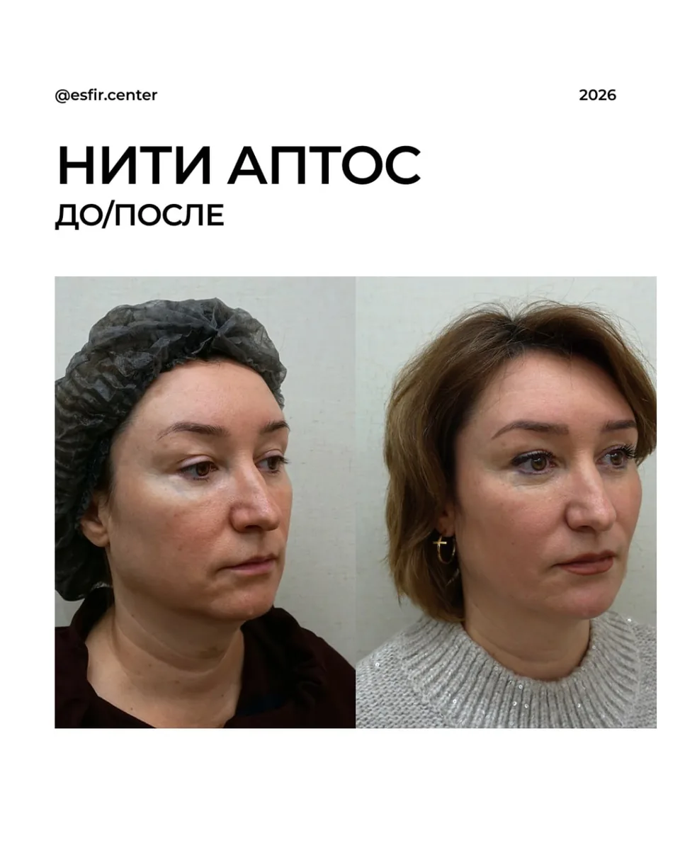 Коррекция второго подбородка нитями Aptos: фото 2