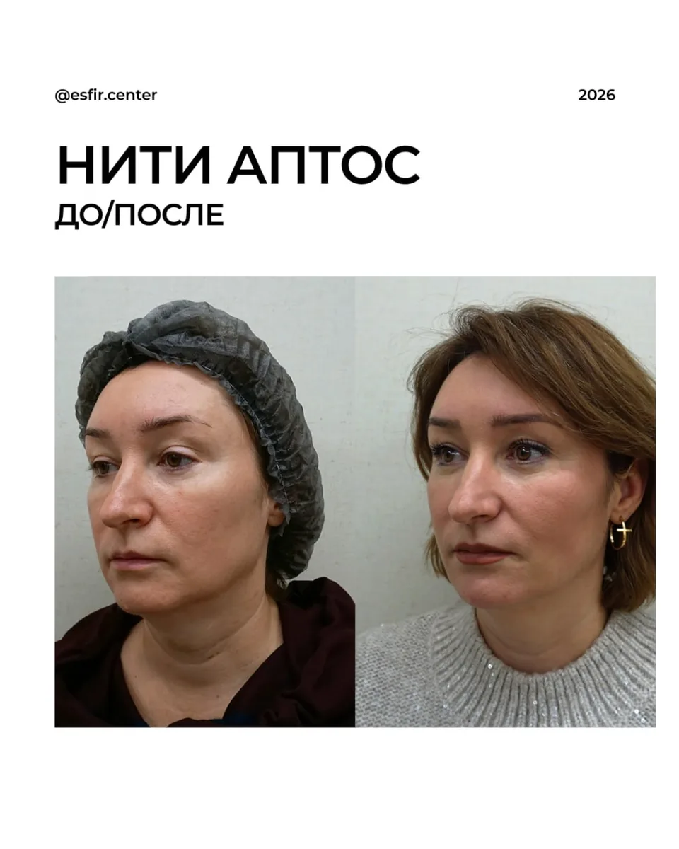 Коррекция второго подбородка нитями Aptos: фото 3